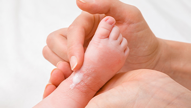 Baby eczema