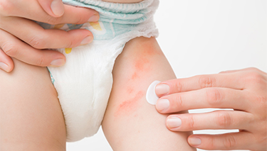 Baby Rashes