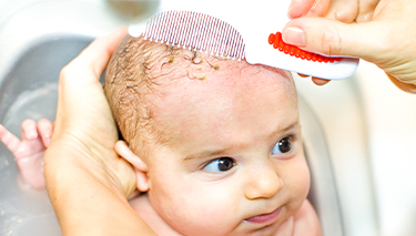 Cradle Cap