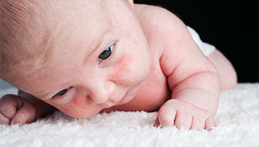 Baby Skin Bumps