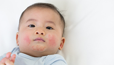 Baby_allergy_Desktop Article Pages 375x213px