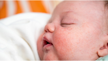 Milk allergy