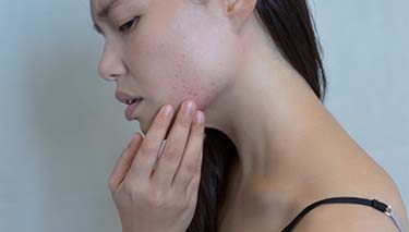 Acne