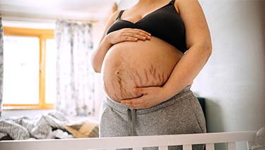 Stretch marks