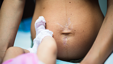 Abdominal Separation
